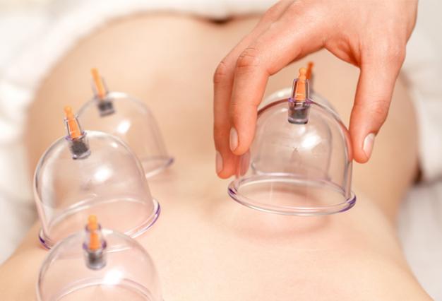 Schröpfbehandlung